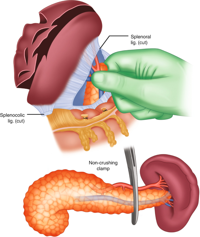 Spleen Removal